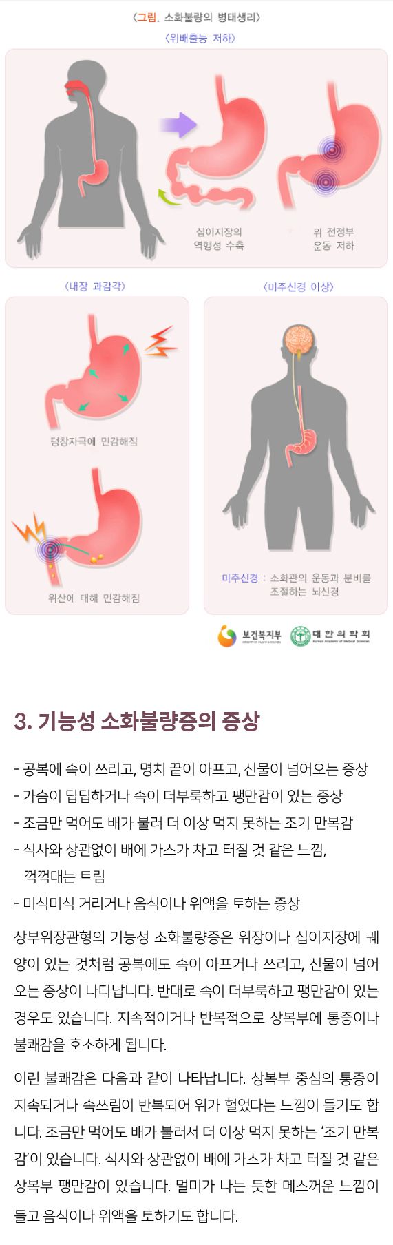 기능성소화불량