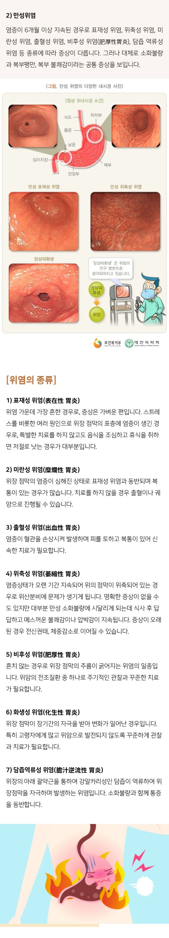 급만성위염