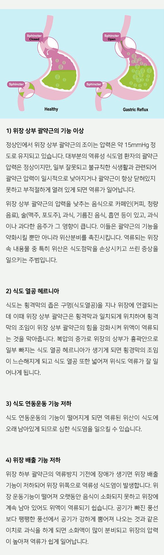 역류성식도염