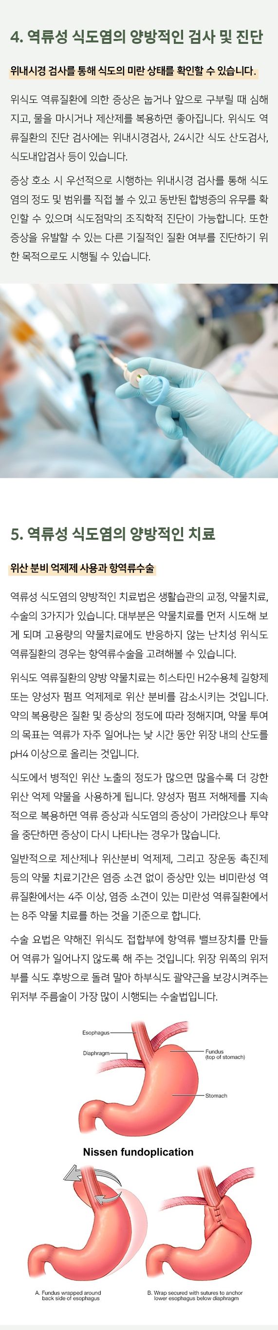 역류성식도염