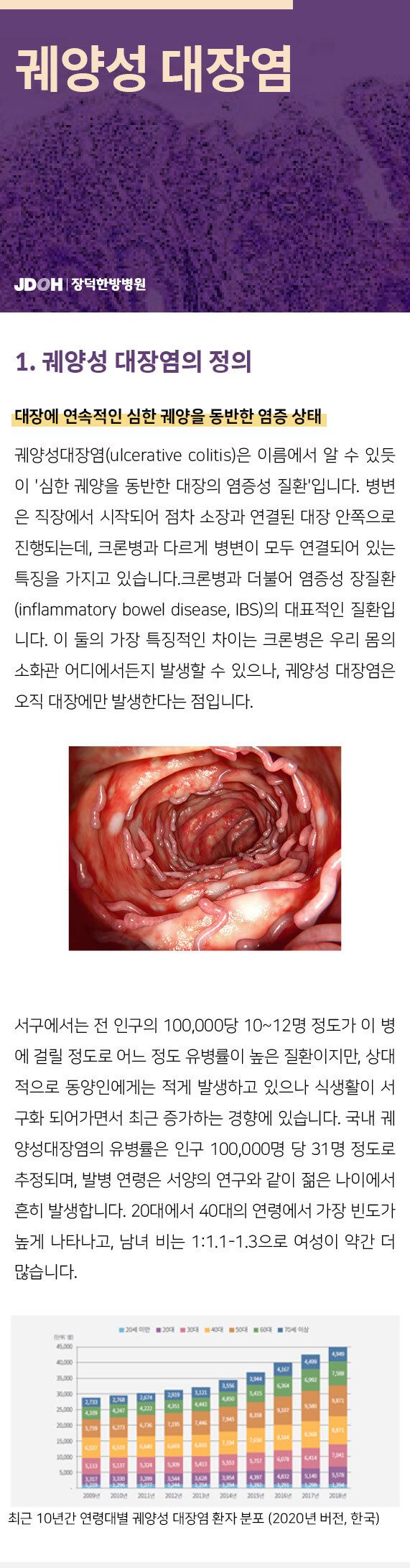 궤양성대장염