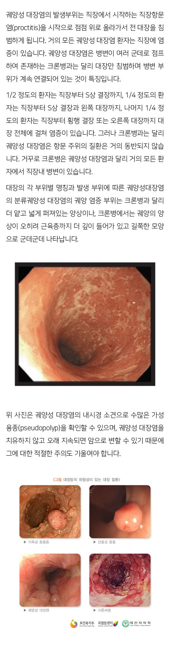 궤양성대장염