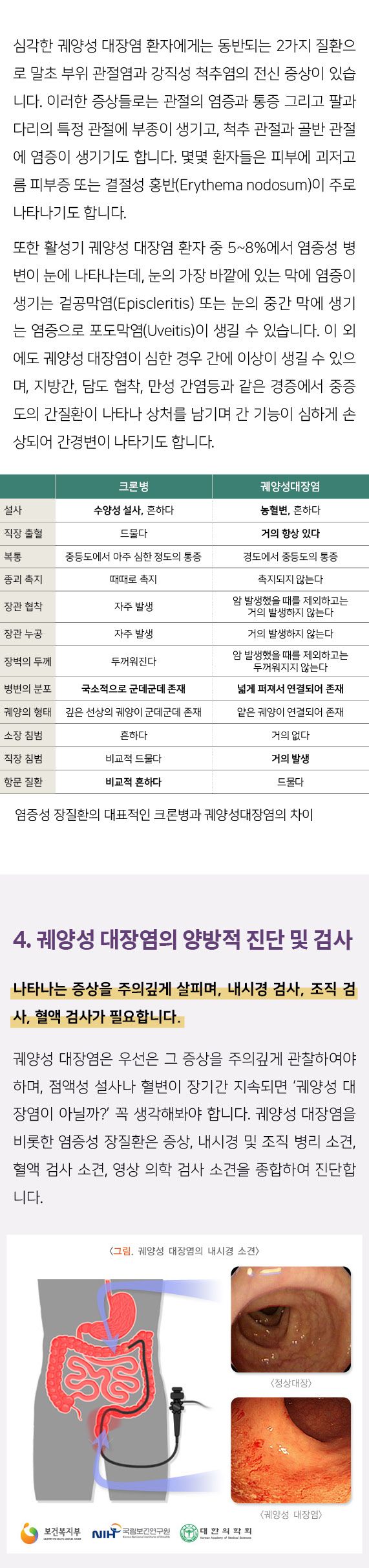 궤양성대장염