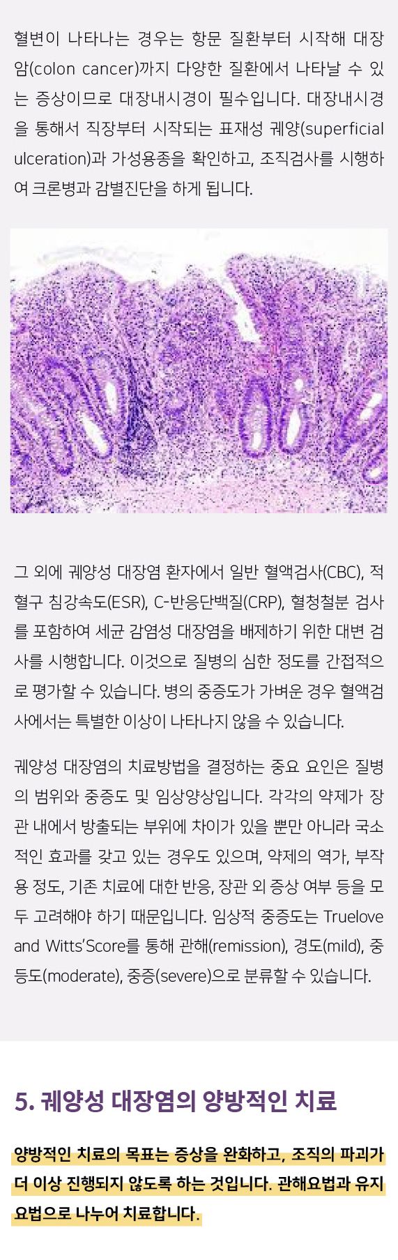 궤양성대장염