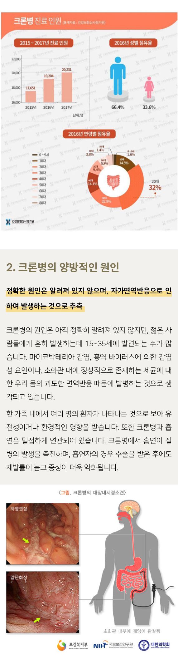 크론병