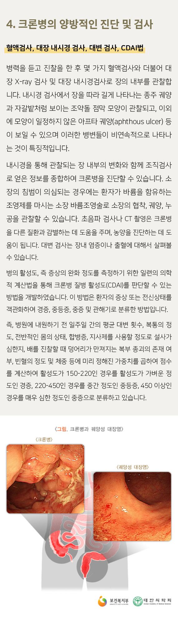 크론병