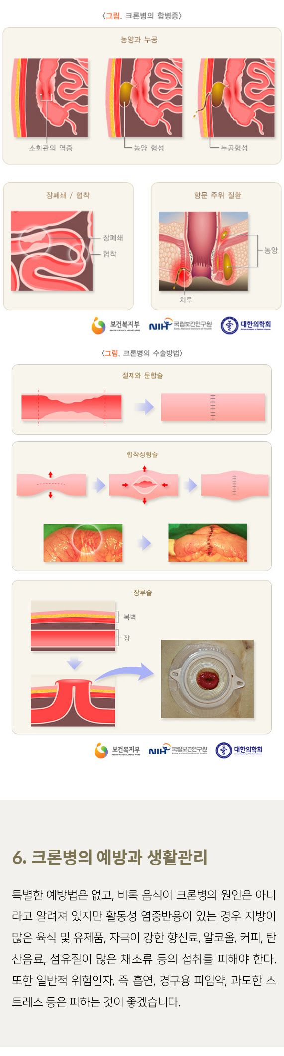 크론병