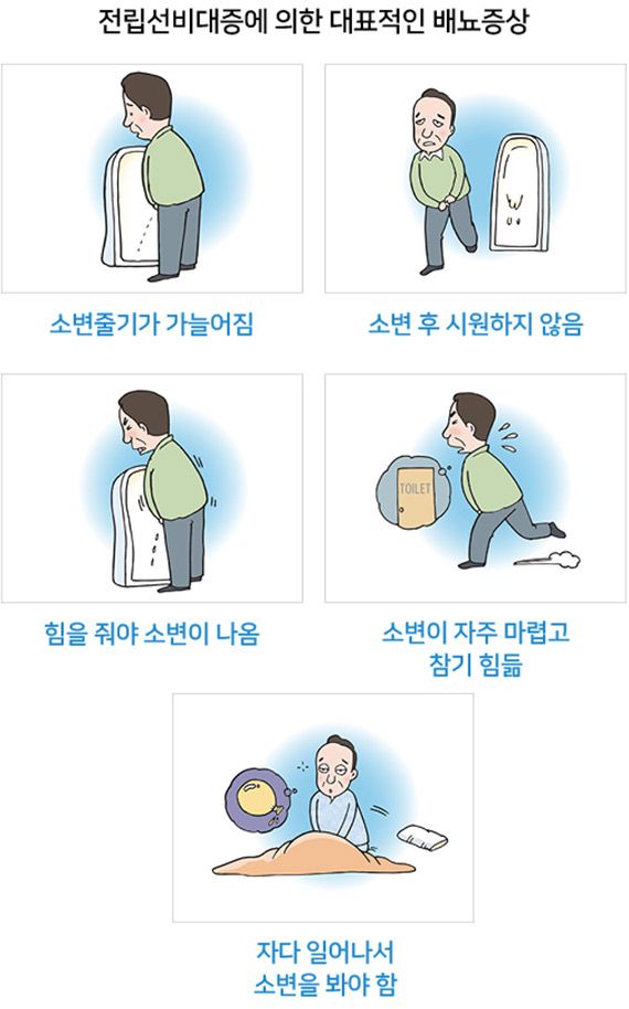 전립선비대증 치료방법과 초기증상, 3